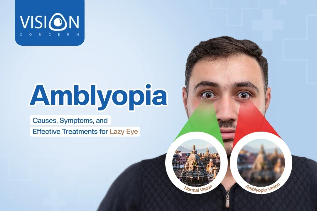 Amblyopia: Causes, Symptoms, and Effective Treatments for Lazy Eye