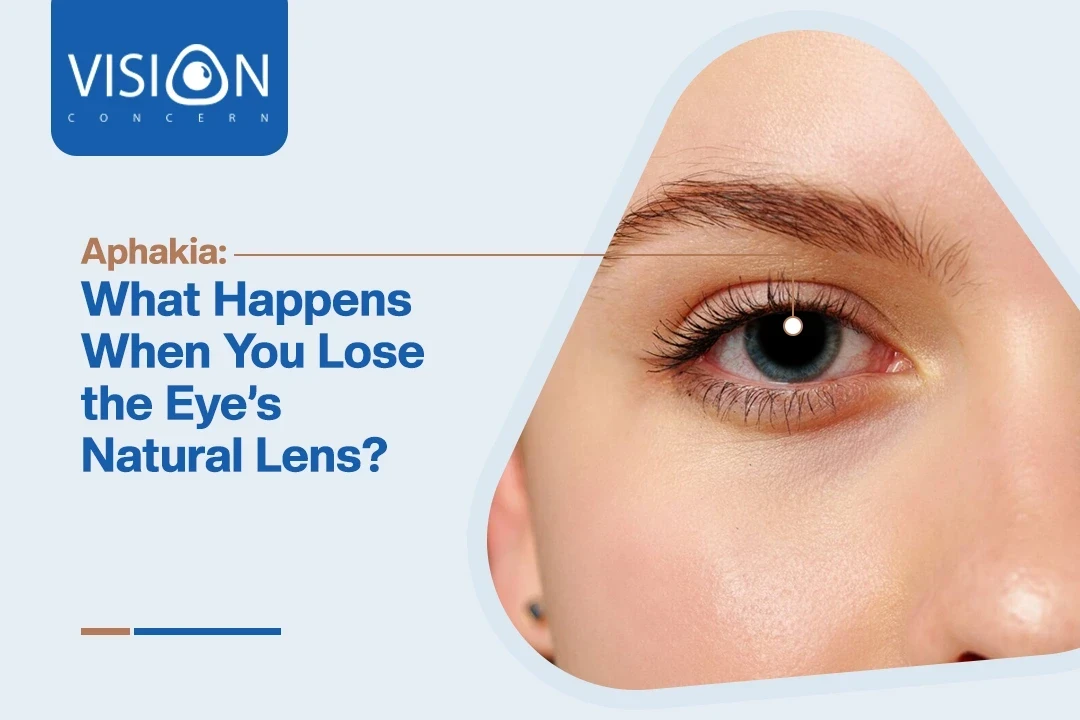 Aphakia: What Happens When You Lose the Eye’s Natural Lens?